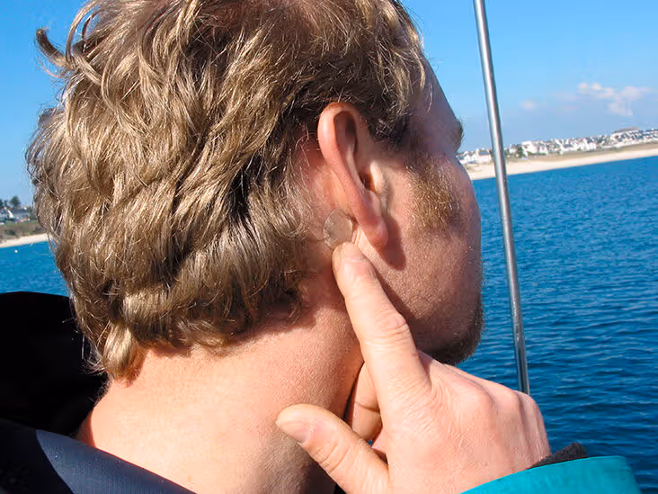 Scopolamine transdermal patch applied behind the ear
